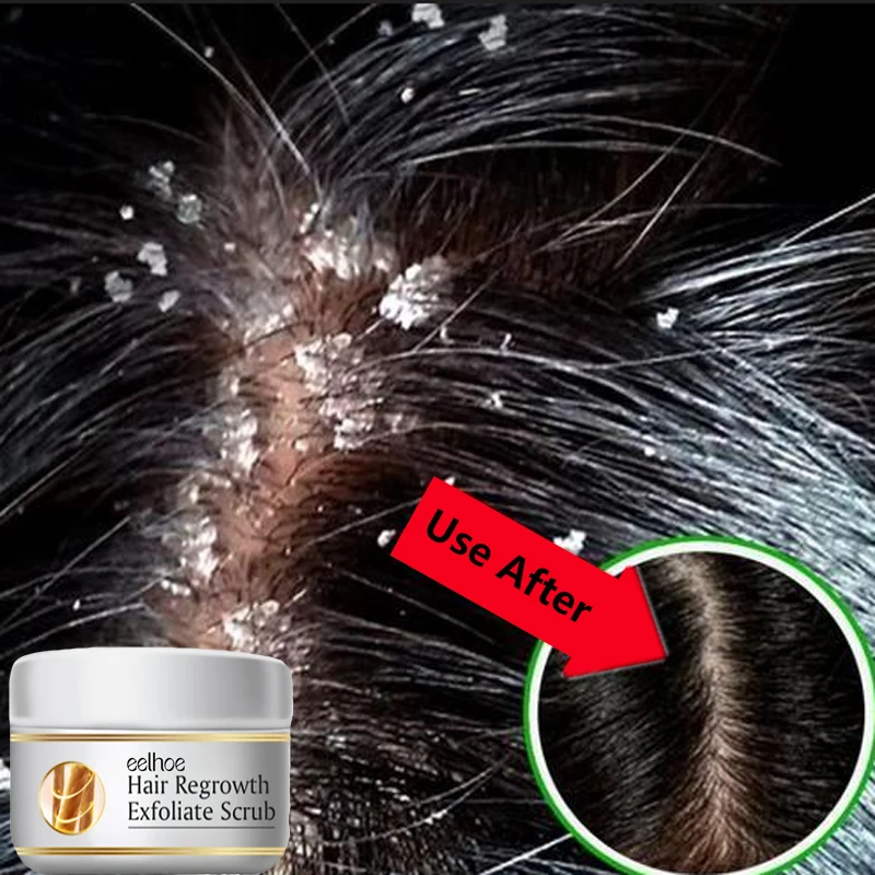 Fast Anti Dandruff Hair Treatm - огляд і ціна Scalp Scrub Exfoliant