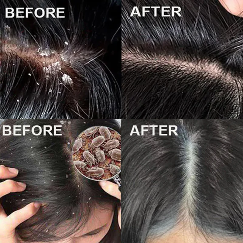Fast Anti Dandruff Hair Treatm - огляд і ціна Scalp Scrub Exfoliant
